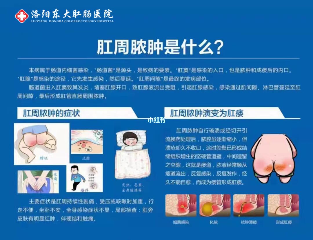 肛周脓肿最新手术方法,肛周脓肿最新手术方法，探索与进步